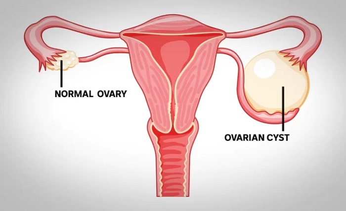 GYNECOLOGY